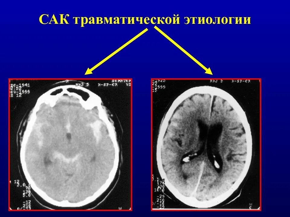 Травматическое субарахноидальное кровоизлияние кт. Травматическое Сак.