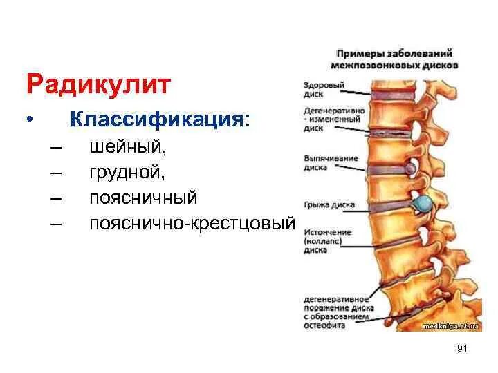 Поясничная радикулопатия лечение. Радикулит пояснично кресцовой. Классификация радикулита. Поясничный поясничный остеохондроз. Пояснично-крестцовой радикулопатии.