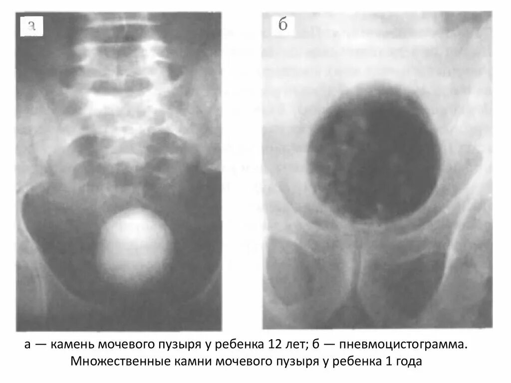 Уролитиаз мочевого пузыря. Камень в мочевом пузыре рентгенограмма. Камни в почках и мочевом пузыре на рентгене. Каменмен в мочевой пузырь. Камни в мочевом у мужчин лечение