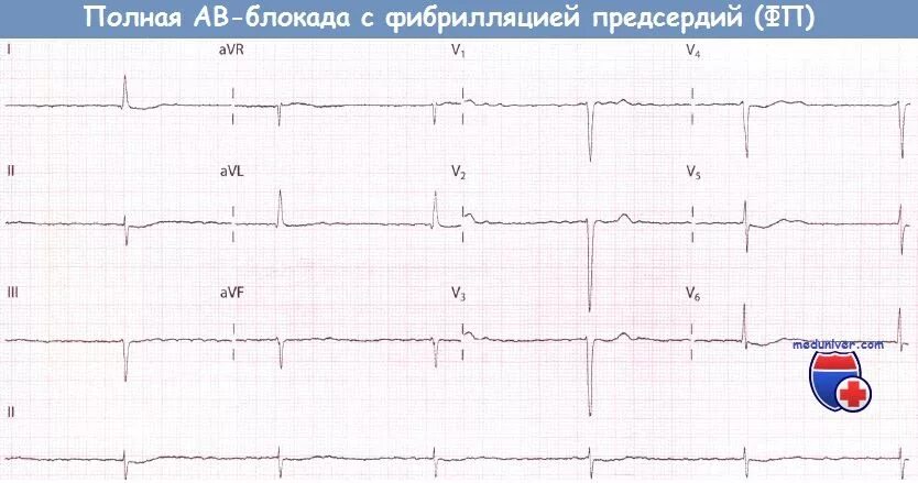 Блокада код по мкб 10. Фибрилляция предсердий с АВ блокадой на ЭКГ. АВ блокада при фибрилляции предсердий. Трепетание предсердий с АВ блокадой. Фибрилляция предсердий и АВ блокада 3 степени.