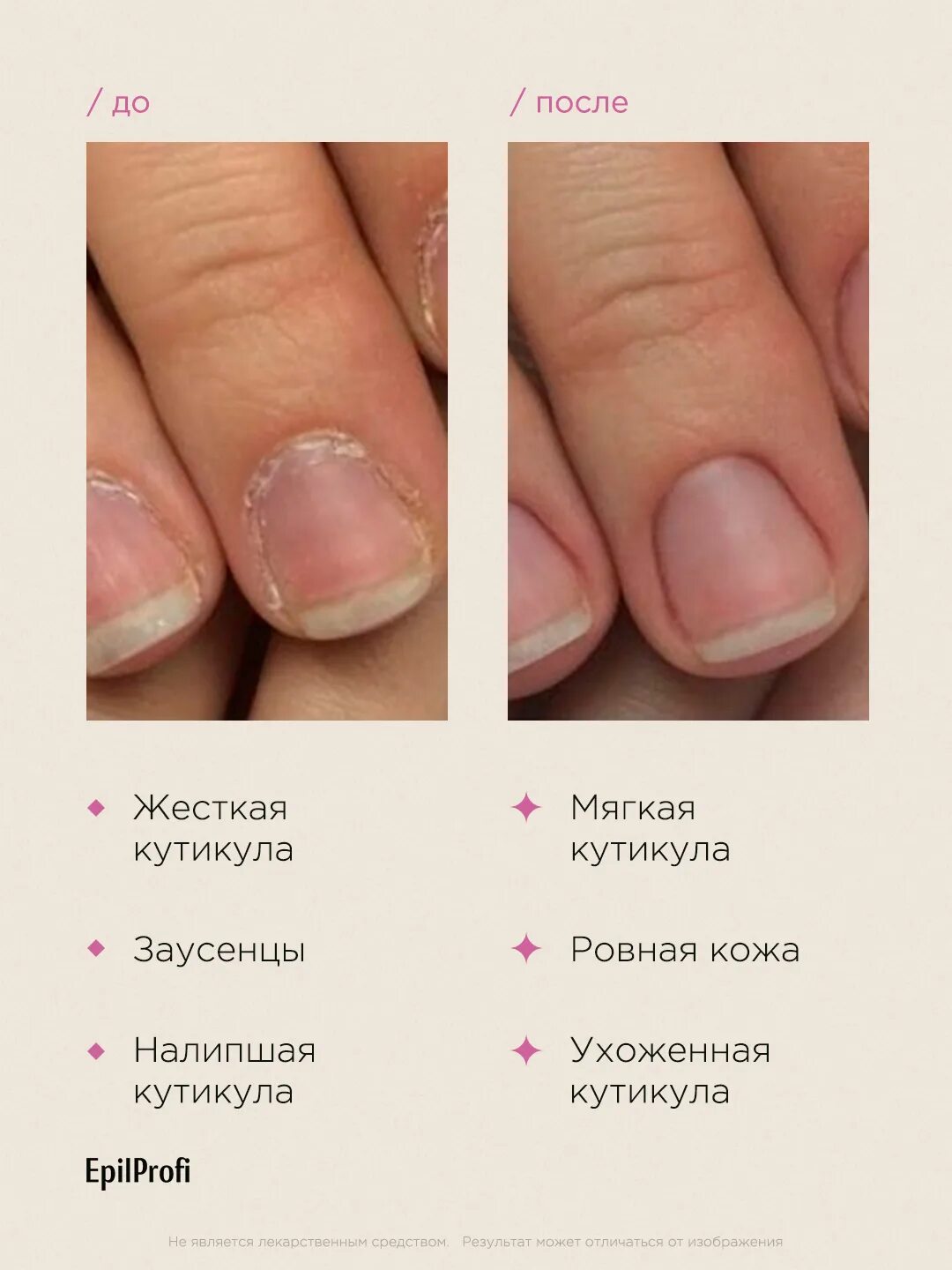 Гель скатка для кутикулы. SOS Manicure гель скатка. Epilprofi для кутикулы. Скатка для кутикулы. Удаление кутикулы.