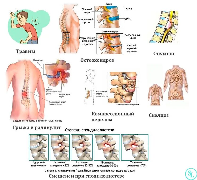 Какая боль в пояснице при грыже. Смещение грудного позвонка симптомы. Смещен позвонок грудного отдела позвоночника. Смещение позвоночника в поясничном отделе. Смещение позвоночника в грудном отделе.