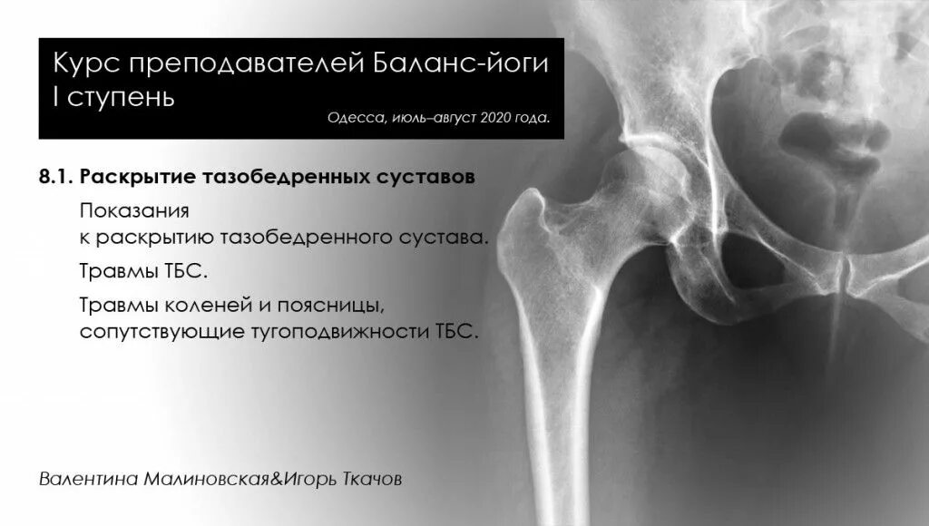 Лимбус тазобедренного сустава это. Раскрытие тазобедренных суставов. раскрыть тазобедренные суставы. раскрытие тазовых суставов. угол раскрытия тазобедренного сустава.