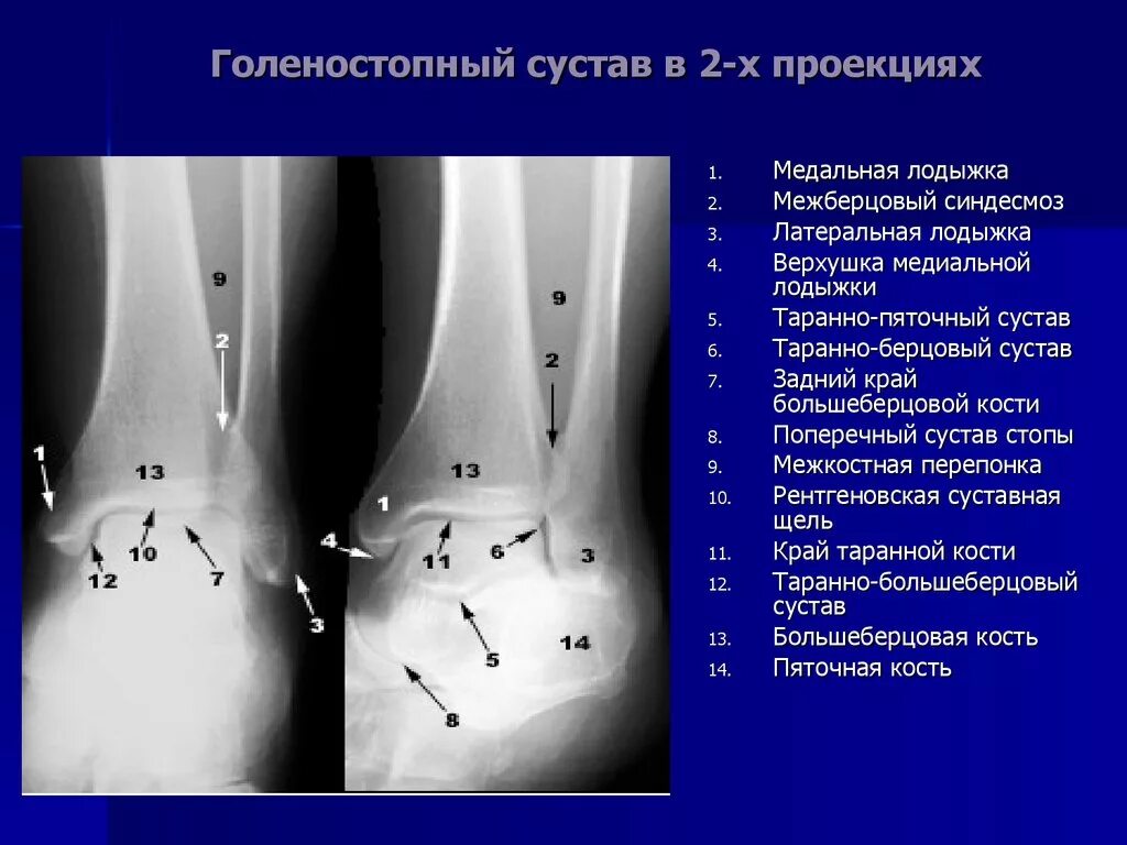 Голеностопный сустав норма. Голеностопный сустав в боковой проекции. Дистальный синдесмоз большеберцовой кости. Связки межберцового синдесмоза. Голеностоп мрт межберцовый синдесмоз.