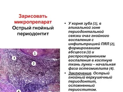 Воспалительная инфильтрация это