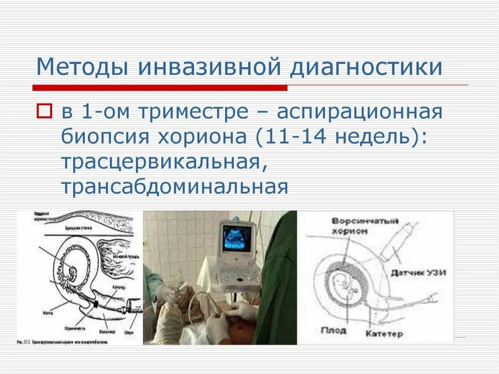 Инвазивный тест при беременности. Инвазивные методы пренатальной диагностики таблица. УЗИ инвазивный метод диагностики. Инвазивный метод пренатальной диагностики. Методы пренатальной диагностики биопсия хориона.