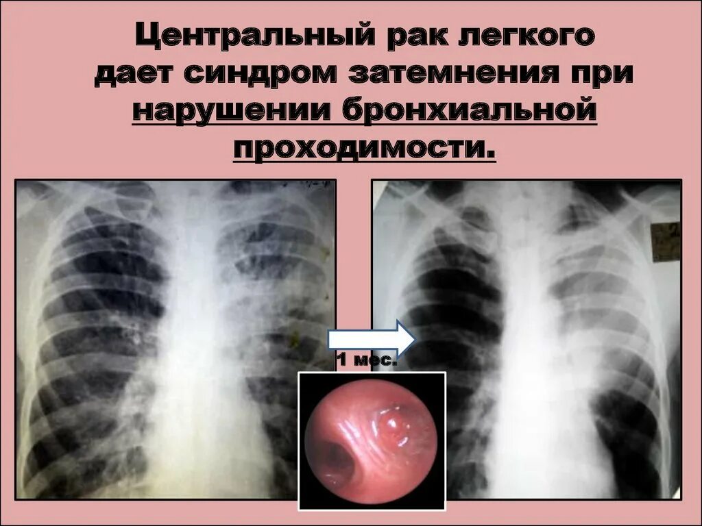 Синдром затемнения легочной ткани. Затемнение легкого на рентгене. Пневмония затемнение в легких.