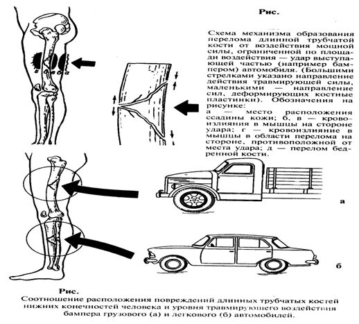 Механизм образования бампер перелома. Бампер перелом голени судебная медицина. Бампер перелом голени судебная медицина механизм. Механизм образования повреждений от авто.