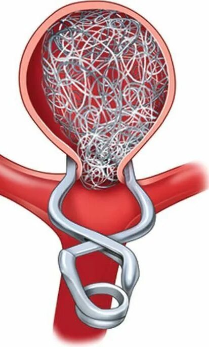 Эндоваскулярная операция аневризмы головного. Эндоваскулярная аневризма головного мозга. Аневризма головного мозга клипса. Аневризма головного клипирование. Клипирование сосудов головного мозга.