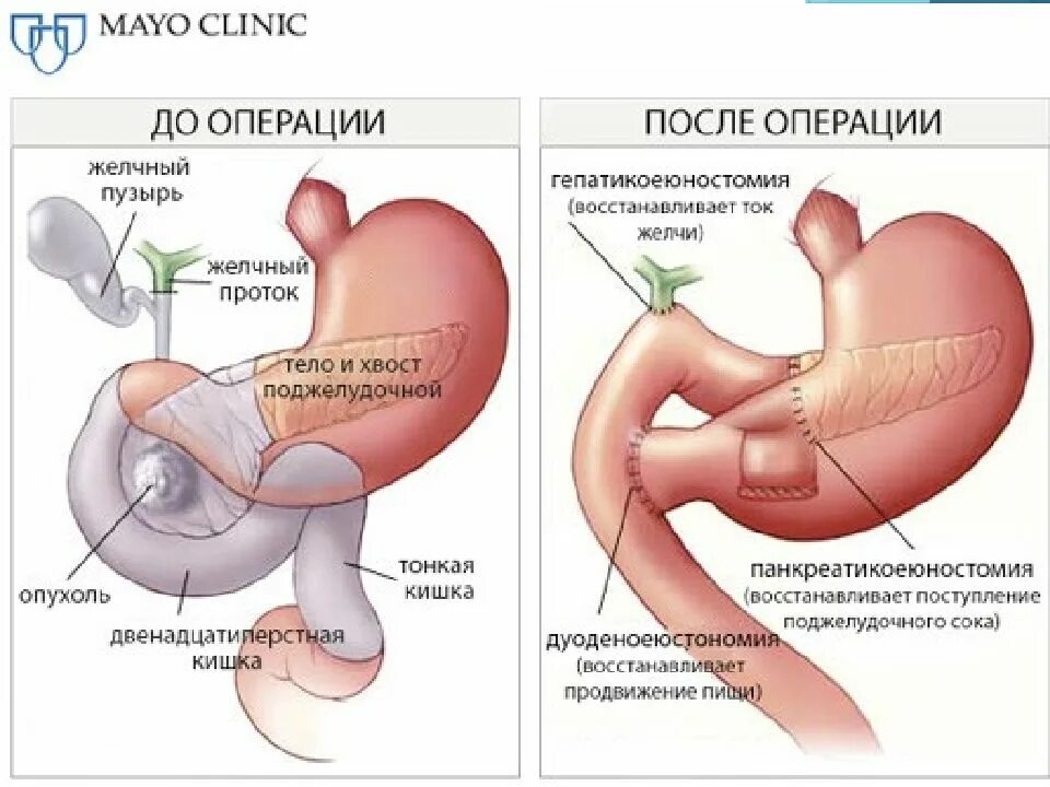 Лечение поджелудочной желчного пузыря. Операция Уиппла на поджелудочной железы. Операция Уиппла (панкреатодуоденальная резекция). Панкреатодуоденальная резекция ход операции.