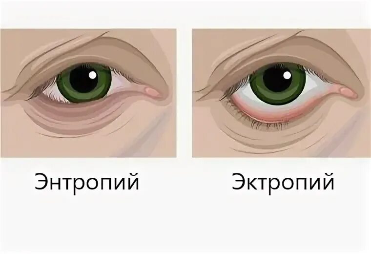 Деформация век. Деформация век