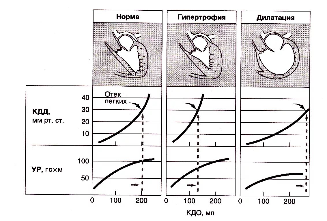 Хроническое легочное сердце осложнения. Синдром хронического легочного сердца. Легочная болезнь сердца. Гипертрофия левого желудочка рентген. Гипертрофия легких.