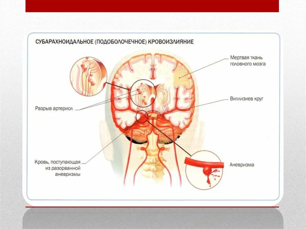 Кровоизлияние в субарахноидальное пространство мозга последствия. Симптомы субарахноидального кровоизлияния. Субарахноидальное кровотечение на кт. Паренхиматозно субарахноидальное кровоизлияние кт.