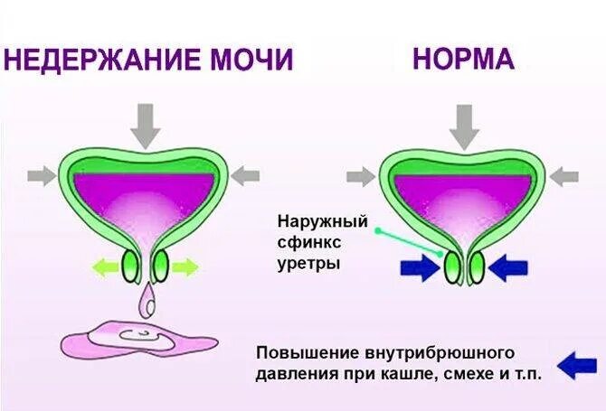 Мочеиспускание происходит непроизвольно у