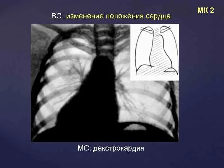 Мс сердца. Горизонтальное расположение сердца. Вертикальное положение сердца. Горизонтальное положение сердца. Вертикальное расположение сердца.