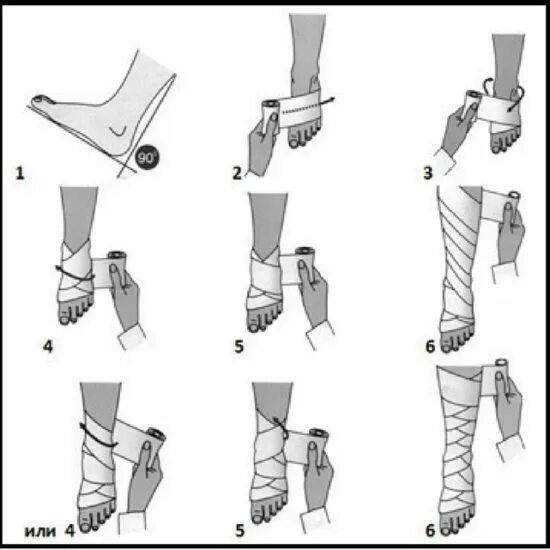 Схема бинтования ноги эластичным бинтом после операции. Схема бинтования ноги эластичным бинтом при варикозе. Схема бинтования голеностопа эластичным бинтом. Схема бинтования голени эластичным бинтом после операции. Сколько носить эластичный бинт на ноге