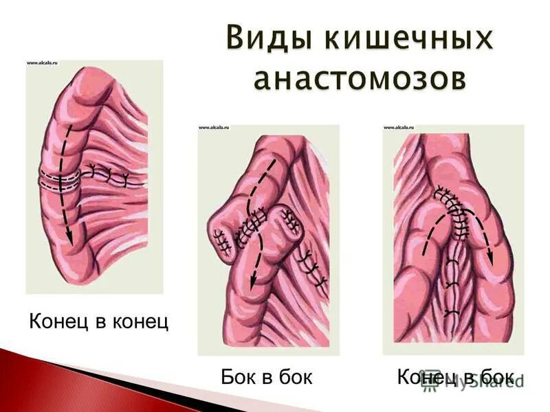 тонкокишечный анастомоз конец в конец. тонкокишечный анастомоз конец в конец. типы кишечных швов и анастомозов. кишечный анастомоз конец в бок. анастомоз кишечника шов.