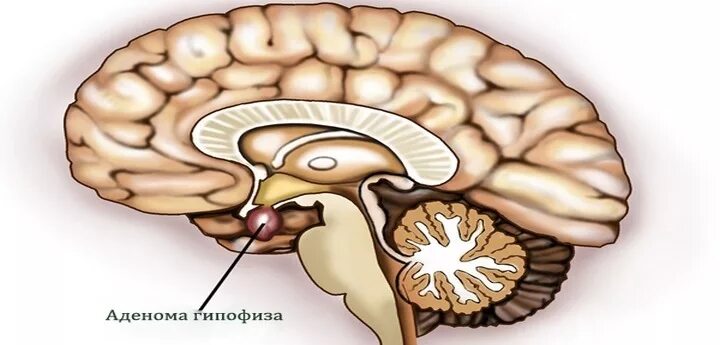 Аденома гипофиз мозга что это такое. Аденома гипофиза головного мозга что это такое. Опухоль аденома гипофиза. Синельников аденома гипофиза. Мкббмкб аденома гипофиза.
