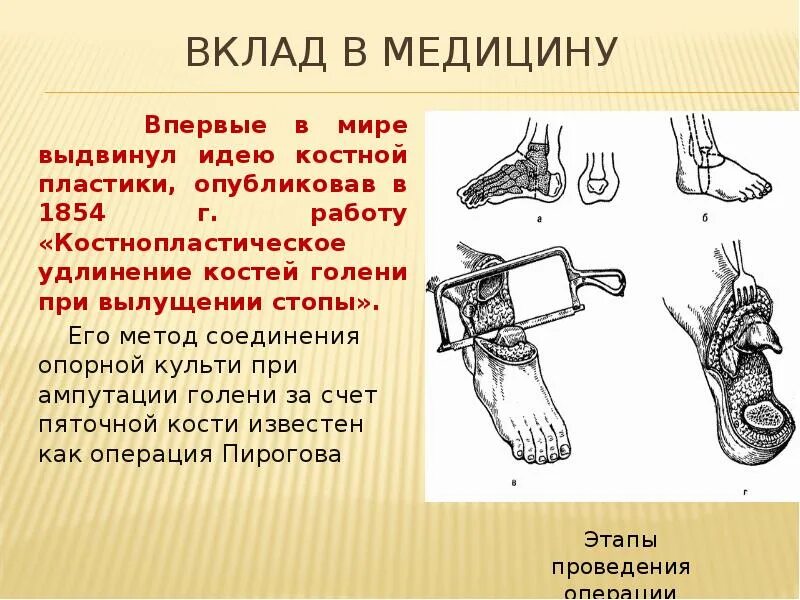 Костно пластическая ампутация голени по Пирогову. Костно-пластическая ампутация стопы по Пирогову. Костно-пластическая ампутация голени по н.и. Пирогову. Ампутация Пирогова голени.