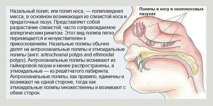 Нос не дышит и течет. Полипоз слизистой носа. полипы околоносовых пазух. наиболее частая локализация полипов в носу.