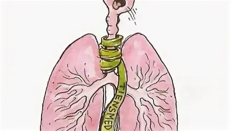 Трахеобронхит без кашля. Трахейный бронхит симптомы. острый гнойный трахеобронхит. псевдомембранозный трахеобронхит.