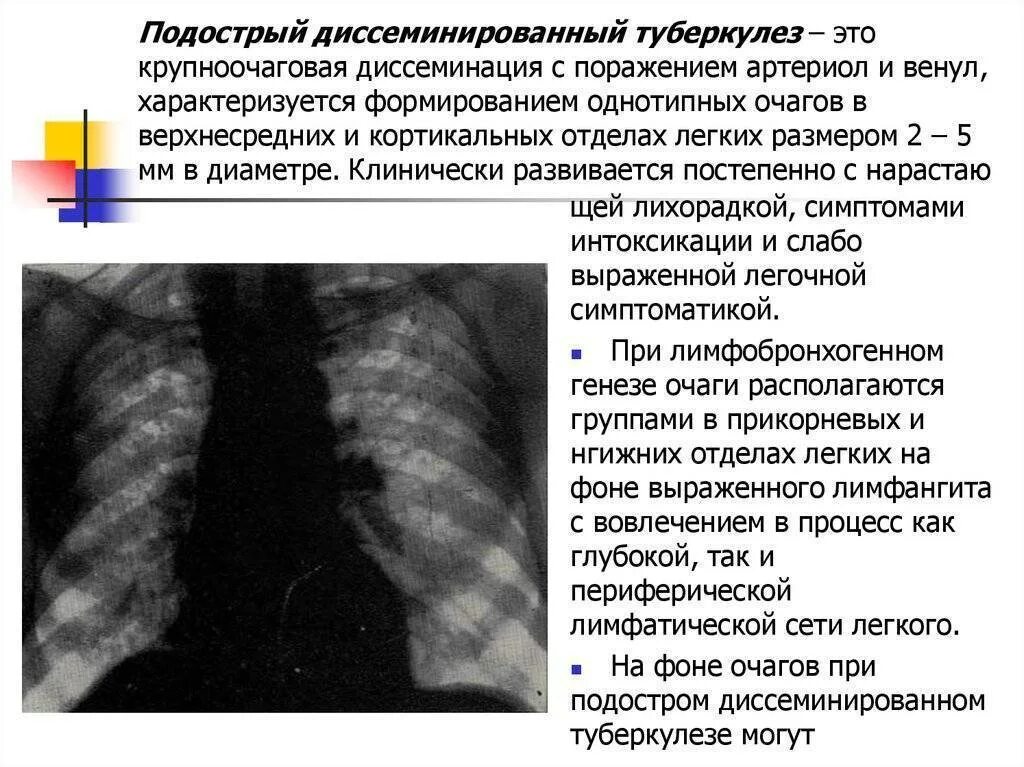 Диссеминированный туберкулез в фазе инфильтрации. Рентгенологические симптомы диссеминированного туберкулеза. Подострый диссеминированный туберкулез. Острый диссеминированный туберкулез рентген. Диссеминированное поражение легких