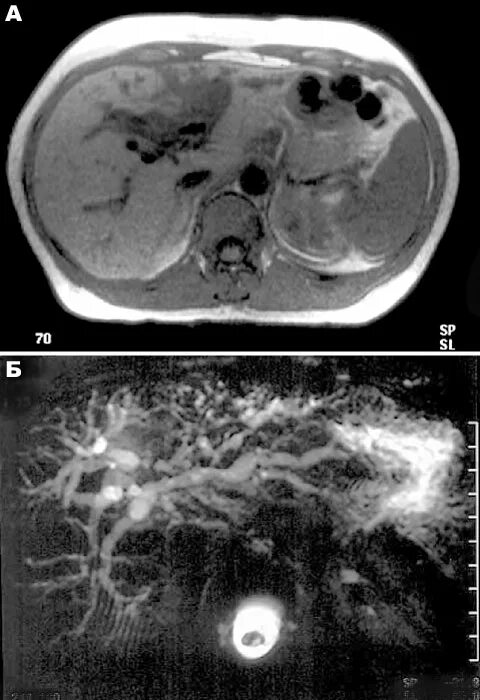 Доброкачественное образование печени. Холангиокарцинома печени кт. Мрт печени +холангиография. Холангиокарцинома мрт.