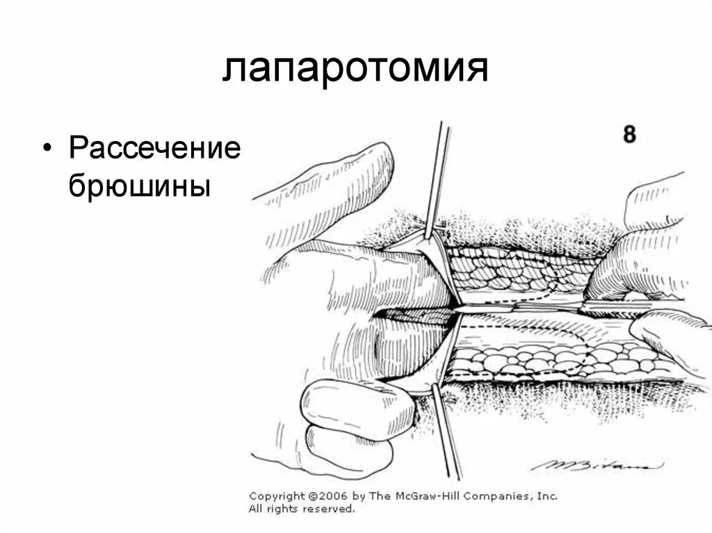 Лапаротомия что это такое простыми словами. Перитонит лапаротомия. Лапаротомия в гинекологии. Лапаротомическая миомэктомия.