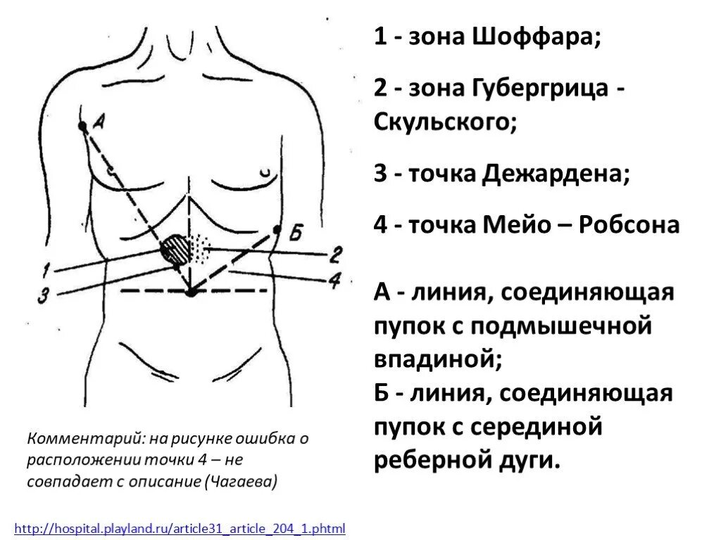 Точки болезненности. Точка Дежардена, точка Мейо-Робсона. Точка Дежардена и зона Шоффара точка Мейо-Робсона.