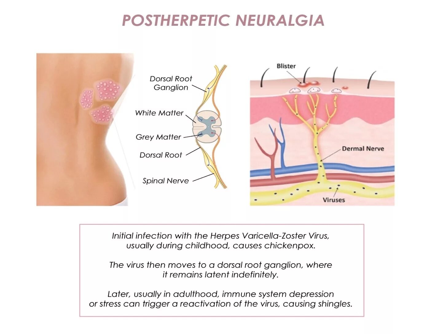 Neuralgia латынь