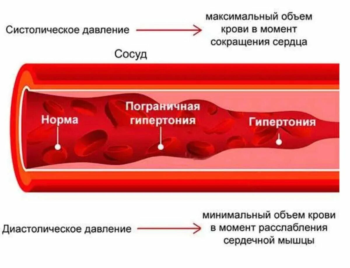 При высоком давлении сосуды расширяются или сужаются. Сужение сосудов и расширение ,давление. При высоком давлении сосуды сужаются. Высокое давление сосуды сужены или расширены.