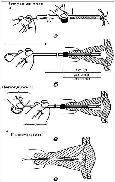 Введение вмс. Техника введения внутриматочной спирали. Введение ВМС алгоритм. Схема введения ВМС Мирена. Введение ВМС Мирена техника.