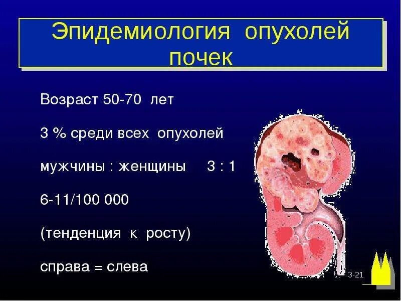 Эпидемиология опухолей. Опухоли почек классификация. Рак почки рекомендации