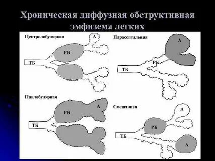 Парасептальная эмфизема