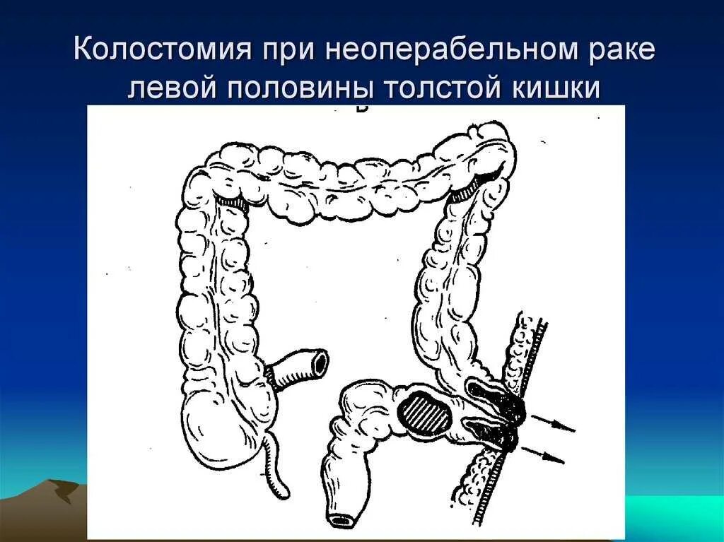 Колостома -Стома толстой кишки.. Операция двуствольная колостома. Колостома сигмовидной кишки. Колэктомия это