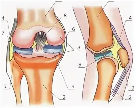 Хондромаляция внутреннего мыщелка бедренной кости 4 степени. Хондромаляция бедренной кости 4 степени. Мыщелковая кость коленного сустава. Хондромаляция медиального мыщелка бедренной кости 4 степени.