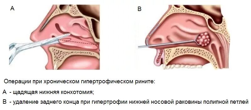 Вазотомия лазером. Подслизистая вазотомия носовых. Конхотомия нижних носовых раковин. Эндоскопическая резекция средней носовой раковины что это. Эндоскопическая шейверная конхотомия.