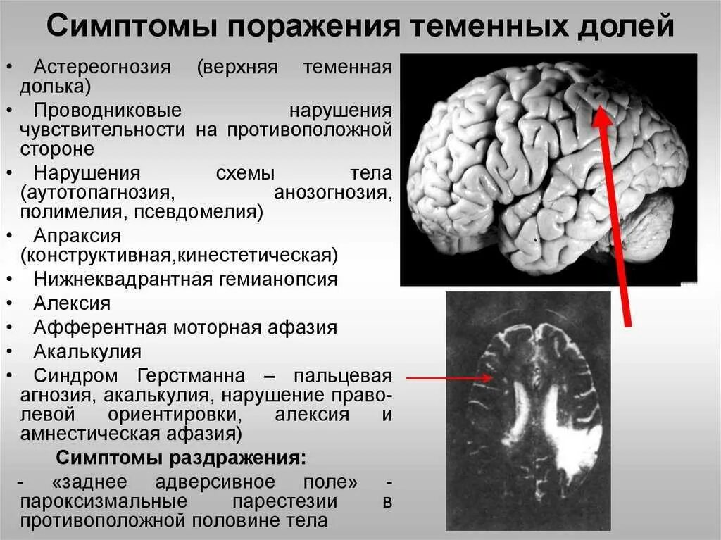 Синдромы поражения теменной доли. Симптомы поражения теменной доли мозга. Синдром теменной доли неврология. Симптомы поражения коры лобной доли головного мозга. Опухоли теменной