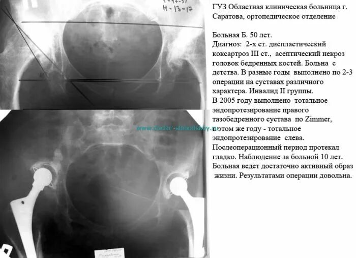 При коксартрозе дают инвалидность