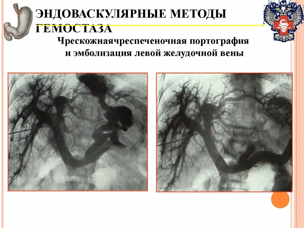 Что такое экстравазация
