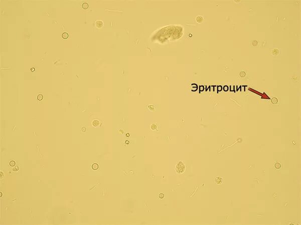 Эритроциты выщелоченные микроскопия. Выщелоченные эритроциты в моче под микроскопом. Эритроциты в моче микроскопия. Эритроциты в моче под микроскопом. Появление эритроцитов в моче