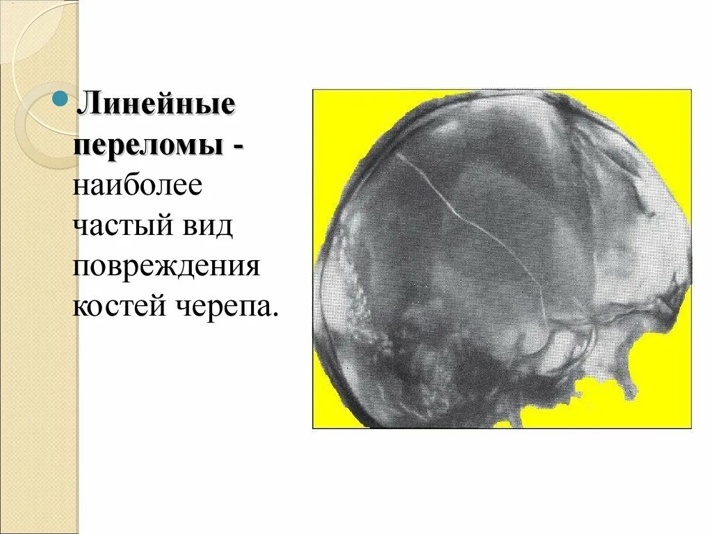 Перелом кости свода черепа. ЧМТ повреждения костей черепа. Линейные переломы костей черепа. Линейный перелом черепа. Линейный перелом костей свода черепа.