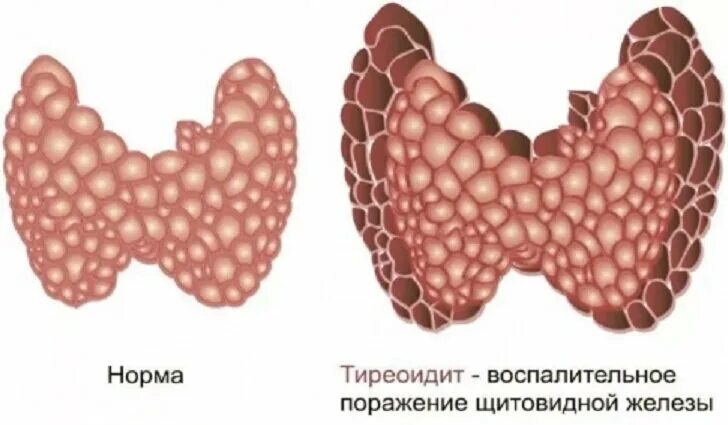 Гранулематозный тиреоидит. Подострый тиреоидит Кервена. Гранулематозный тиреоидит щитовидной железы. Аутоиммунный тиреоидит.