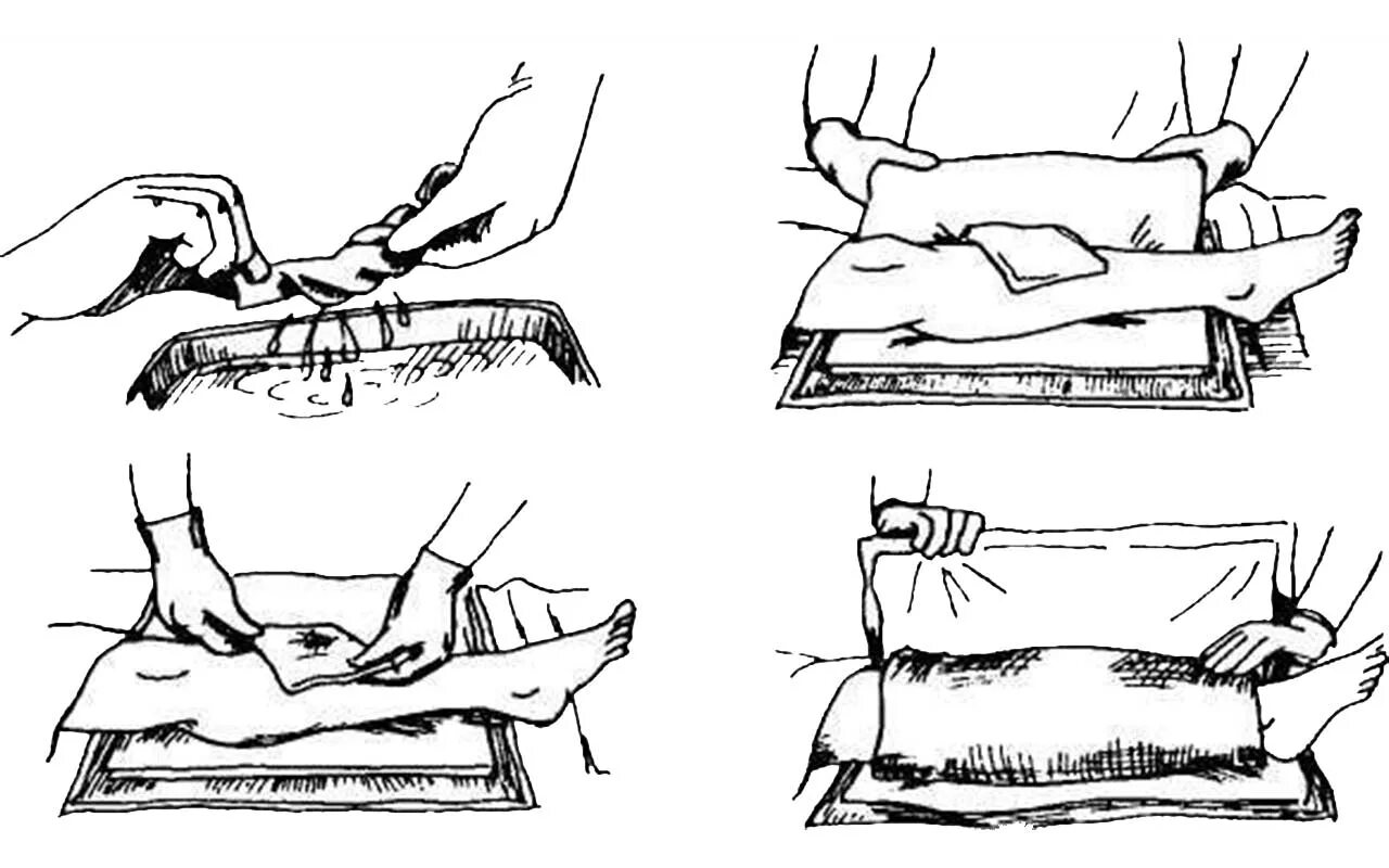 Техника наложения компресса. Согревающий компресс алгоритм постановки. Техника наложения полуспиртового компресса. Алгоритм постановки охлаждающего компресса.