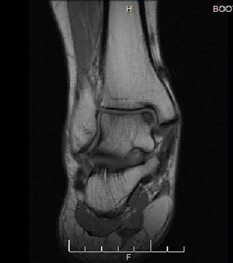 Рассекающий остеохондрит таранной кости рентген. Рассекающий остеохондрит кт. Рассекающий остеохондрит коленного сустава мрт. Рассекающий остеохондрит таранной кости голеностопного сустава.
