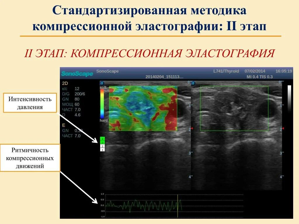 Эластография щитовидной железы что это. Ультразвуковая компрессионная эластография. Эластография протокол УЗИ. Компрессионная эластография молочных желез протокол. Компрессионная эластография щитовидной железы.