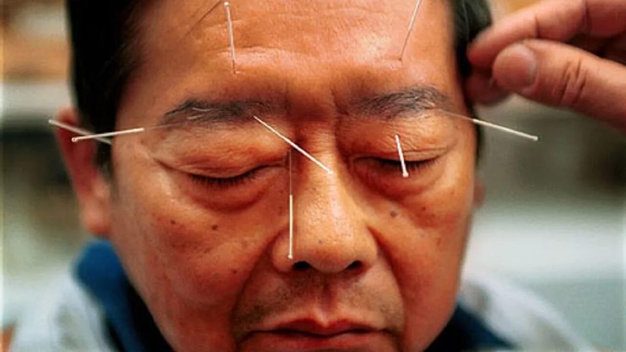 В мозг через глаза. Китайская медицина иглоукалывание. Традиционная китайская медицина иглоукалывание. Китайские иглы для иглоукалывания. Иглоукалывание китайцами.