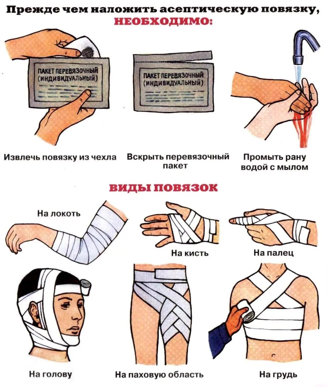 Как перевязать карту. Порядок оказания первой помощи пострадавшему при ранении:. Правила наложения повязок на раны конечностей. Обработка раны первая медицинская помощь. Технику наложения асептической повязки на область РАН.