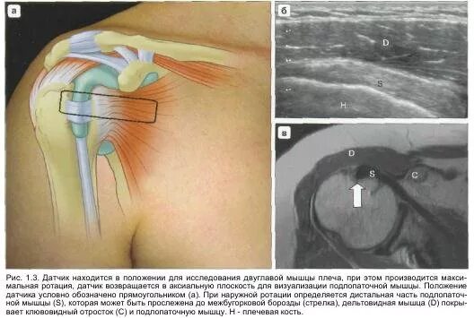 Операция разрыва сухожилия надостной мышцы. Тендинит сухожилия надостной. Тендопатия сухожилия надостной мышцы. Тендинит мышцы плечевого сустава. Ротаторная манжета плечевого сустава УЗИ.