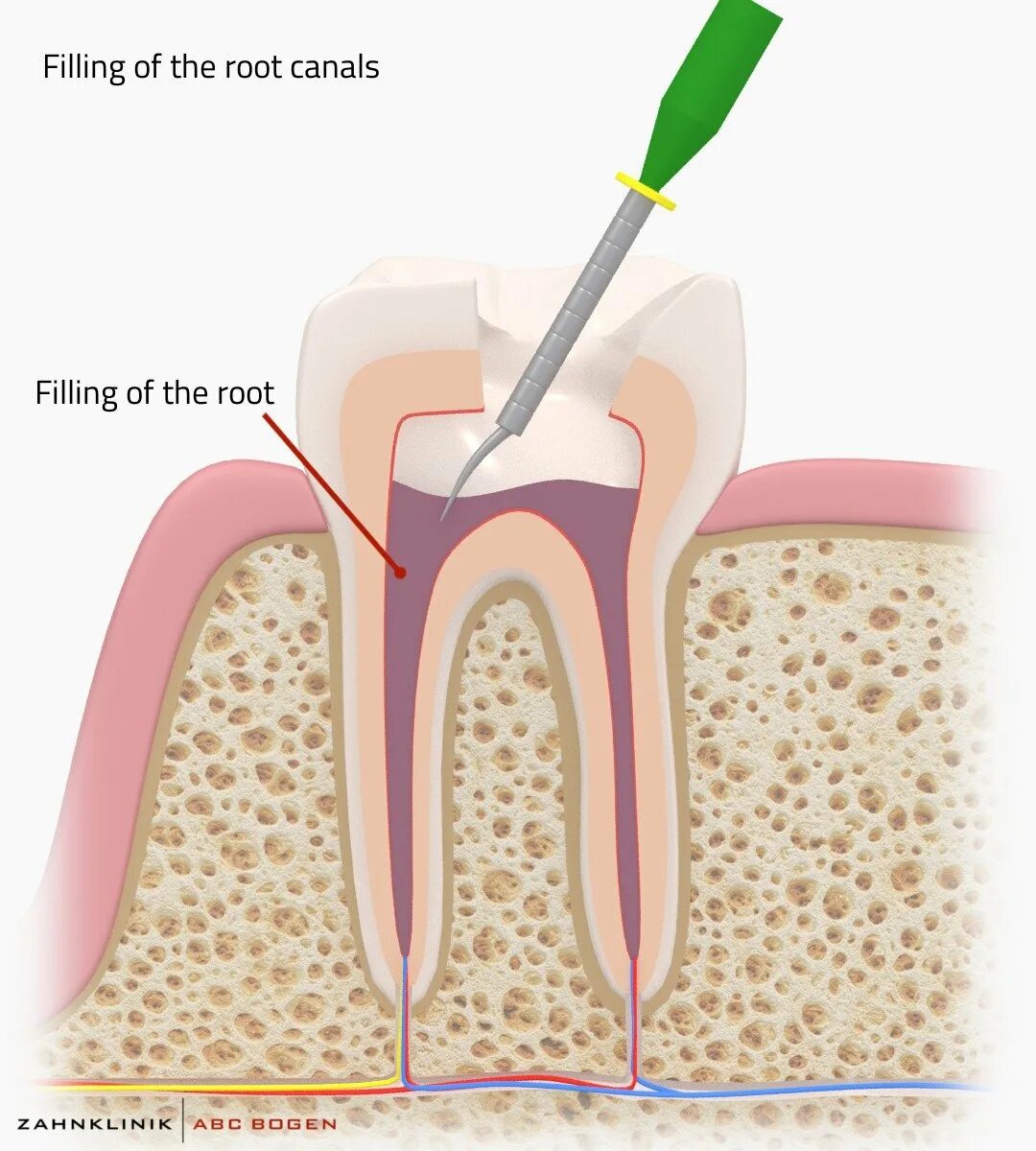 Root canal